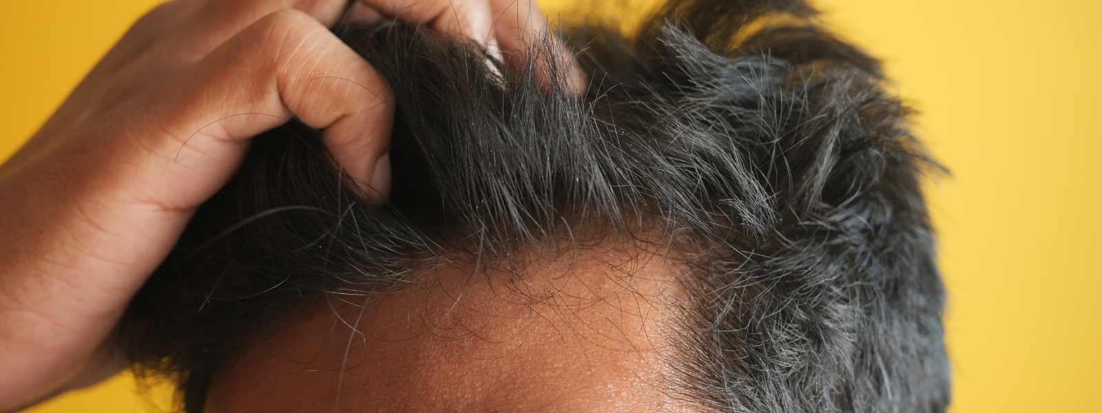 hair loss treatments